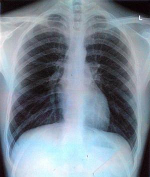 By Aidan Jones from Oxford, UK (chest x-ray)  (Source: Wikimedia Commons)    