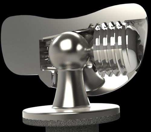 Surgeons can tighten a milled interrupted thread to lock a radial head into the patient's anatomy.  Source: Spiralock