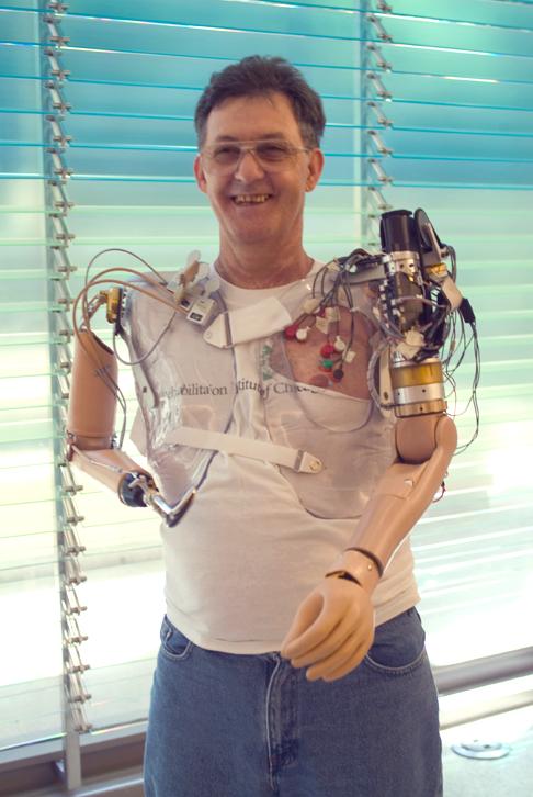 Using a technique called 'nerve reinnervation,' the prosthetic technology used to help Jesse Sullivan takes advantage of his nerves to allow him to move his artificial limbs through thought. (Source: Rehabilitation Institute of Chicago)