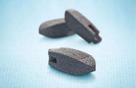 The TM Ardis Interbody System is a lumbar spine implant made with Zimmer's tantalum-based Trabecular Metal (TM) technology, a highly porous metallic substance with characteristics similar to the spongy type of bone.  (Source: Zimmer)
