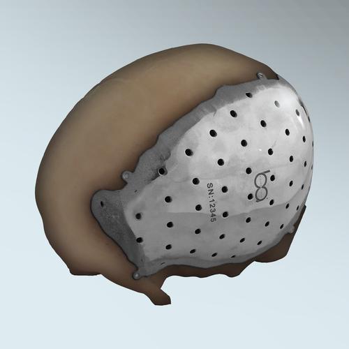 The first patient-specific, 3D-printed, titanium cranial implant in the US has been approved by the FDA, designed by BioArchitects and produced using Arcam's electron beam melting (EBM) process. 3D printing integrates the attachment heads into the plate, improving tensile strength over that of separate attachment brackets used for conventionally made implants. (Source: BioArchitects) 