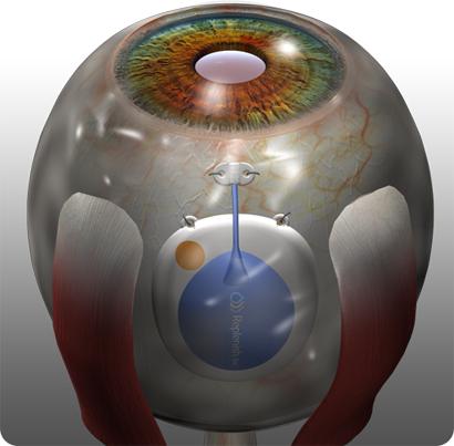 Replenish's implantable micro-fluidic pump can be implanted inside the eye to dispense precise nanoliter-sized doses of drugs as needed for up to nine months before needing a refill.
(Source: Replenish)