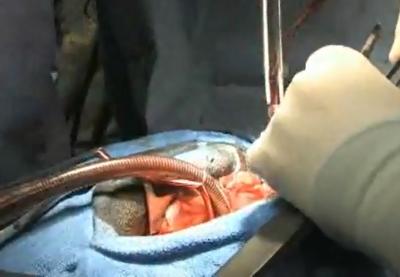 Getting to the heart of the matter, Rich undergoes a sextuple bypass.