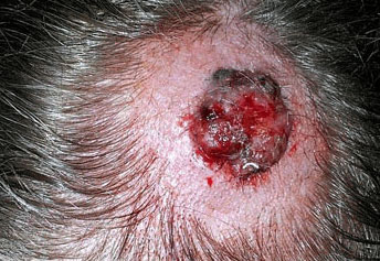 Scalp Lesions | Scalp Problems